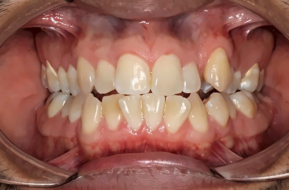 Case 1: before orthodontic treatment at Clínica Nappa Severino