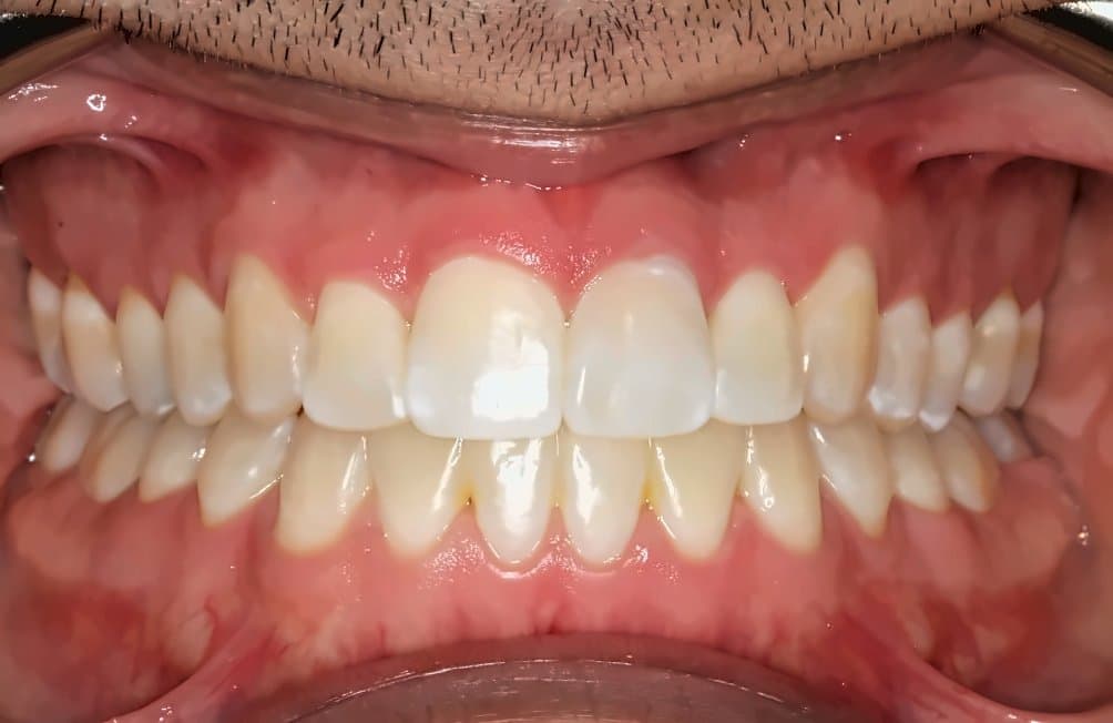 Case 1: after orthodontic treatment at Clínica Nappa Severino