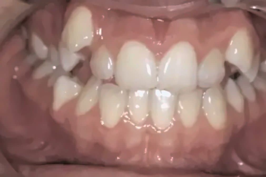 Case 2: before orthodontic treatment at Clínica Nappa Severino