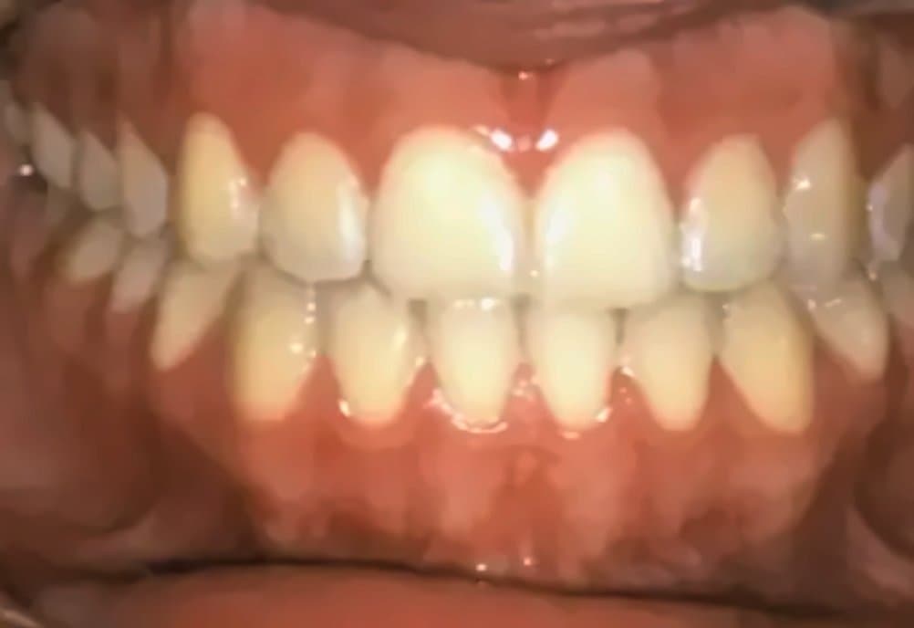 Case 2: after orthodontic treatment at Clínica Nappa Severino