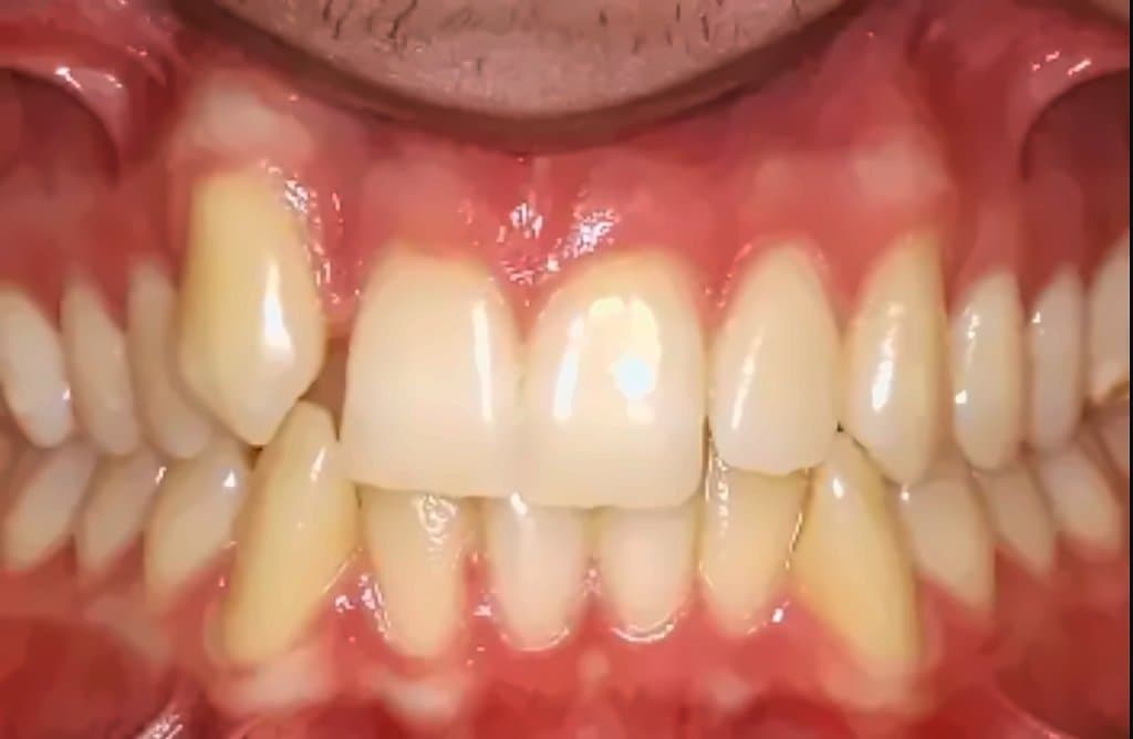 Case 3: before orthodontic treatment at Clínica Nappa Severino