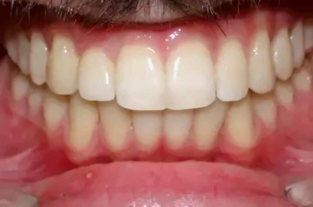 Case 3: after orthodontic treatment at Clínica Nappa Severino